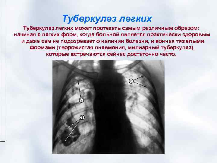     Туберкулез легких может протекать самым различным образом: начиная с легких