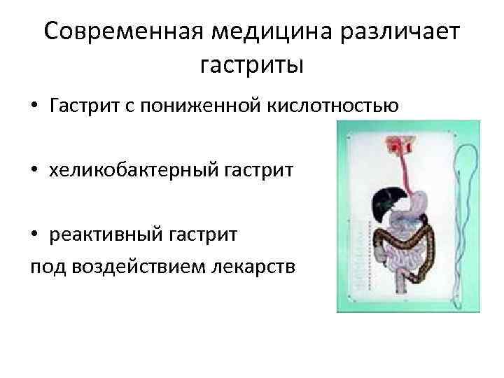  Современная медицина различает   гастриты  • Гастрит с пониженной кислотностью 