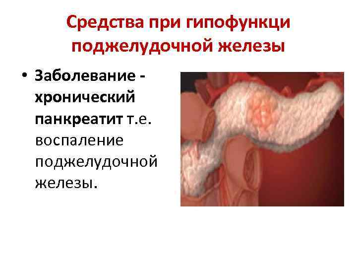  Средства при гипофункци  поджелудочной железы • Заболевание -  хронический  панкреатит
