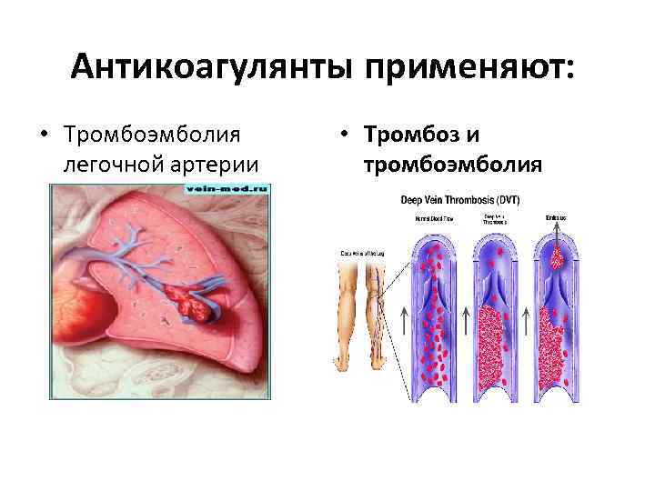  Антикоагулянты применяют:  • Тромбоэмболия  • Тромбоз и  легочной артерии тромбоэмболия