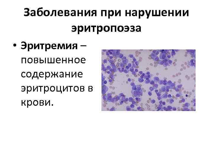  Заболевания при нарушении  эритропоэза • Эритремия –  повышенное  содержание 