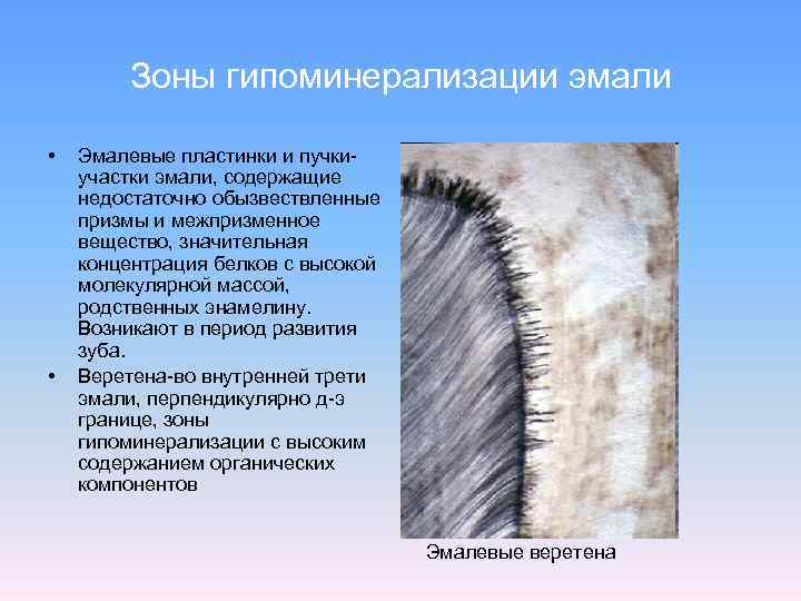   Зоны гипоминерализации эмали  •  Эмалевые пластинки и пучки- участки эмали,