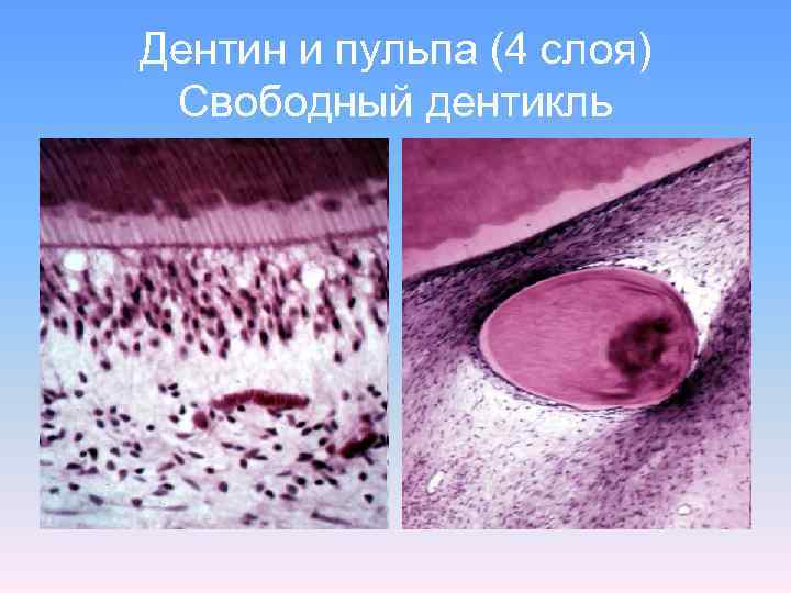 Дентин и пульпа (4 слоя) Свободный дентикль 