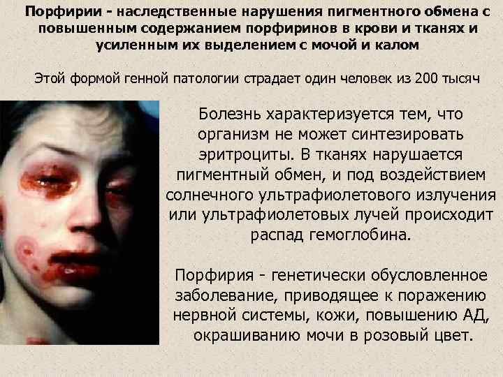 Порфирии - наследственные нарушения пигментного обмена с повышенным содержанием порфиринов в крови и тканях
