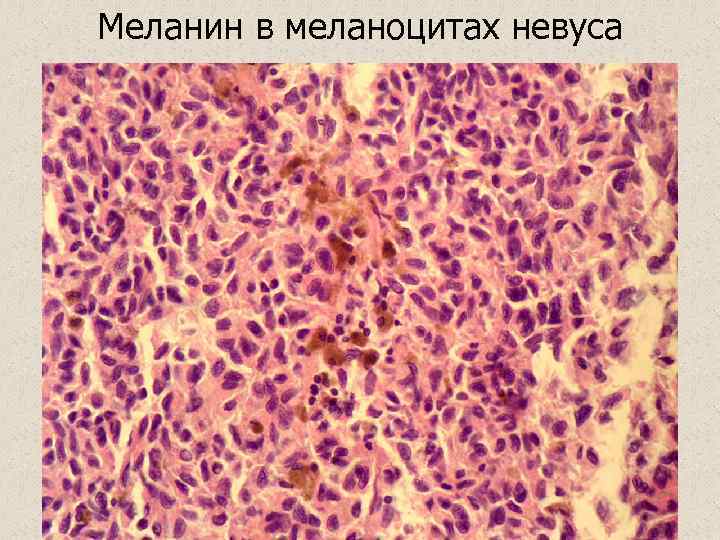 Меланин в меланоцитах невуса 