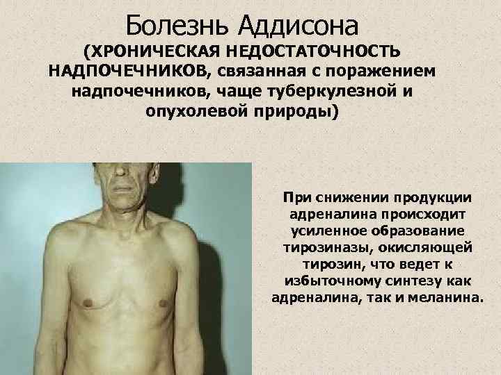   Болезнь Аддисона  (ХРОНИЧЕСКАЯ НЕДОСТАТОЧНОСТЬ НАДПОЧЕЧНИКОВ, связанная с поражением  надпочечников, чаще