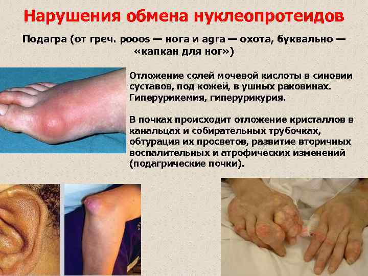 Нарушения обмена нуклеопротеидов Подагра (от греч. pooos — нога и agra — охота, буквально