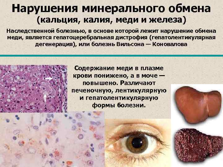 Нарушения минерального обмена   (кальция, калия, меди и железа) Наследственной болезнью, в