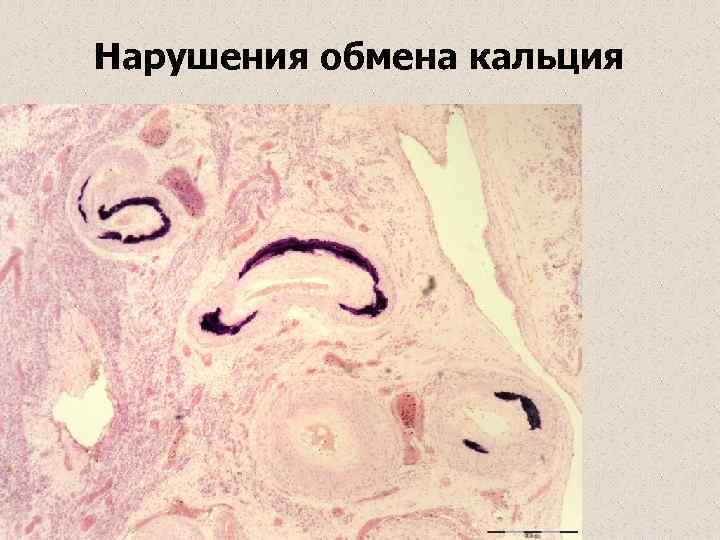 Нарушения обмена кальция 