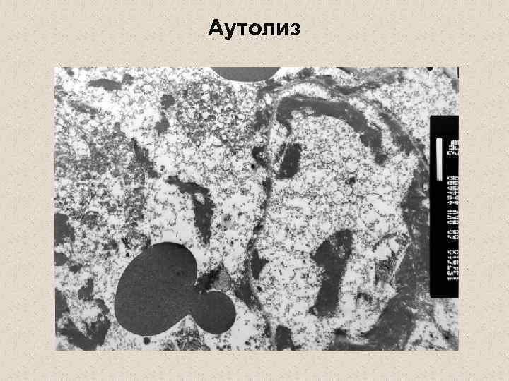 Аутолиз. Аутолиз клетки схема. Трупное самопереваривание (аутолиз).