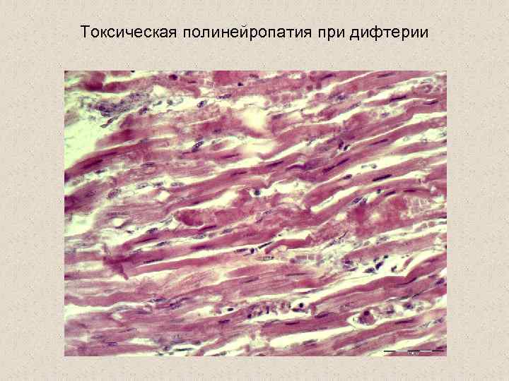 Токсическая полинейропатия при дифтерии 