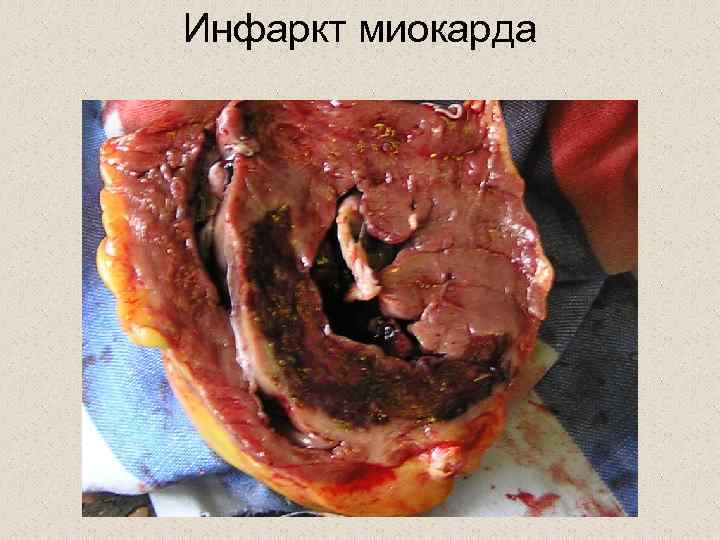 Инфаркт миокарда 