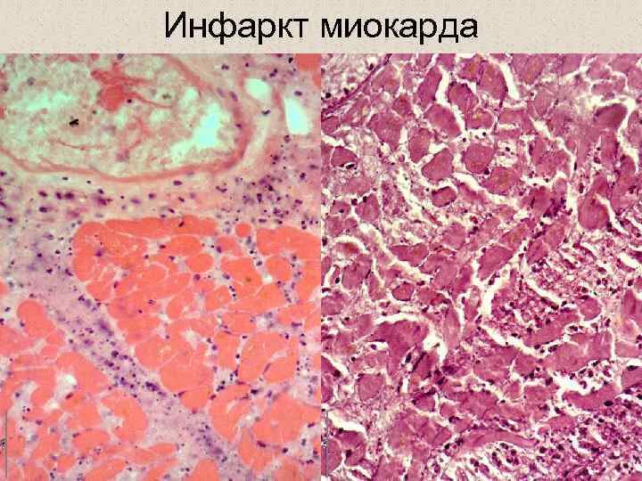 Инфаркт миокарда 