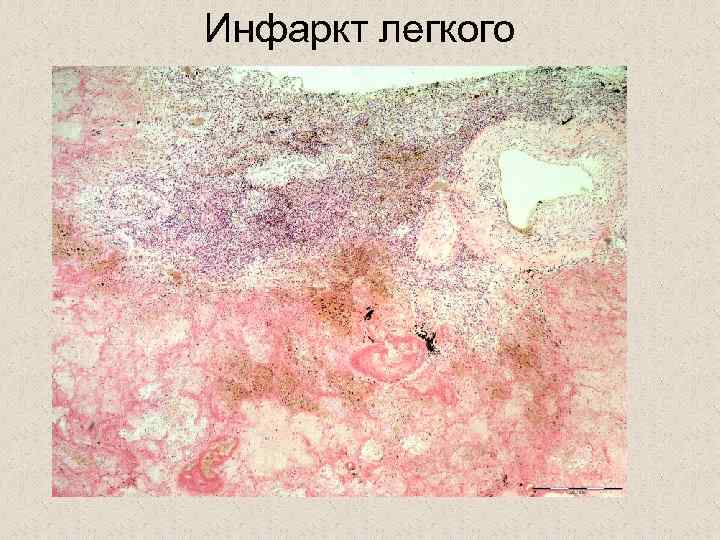 Инфаркт легкого 