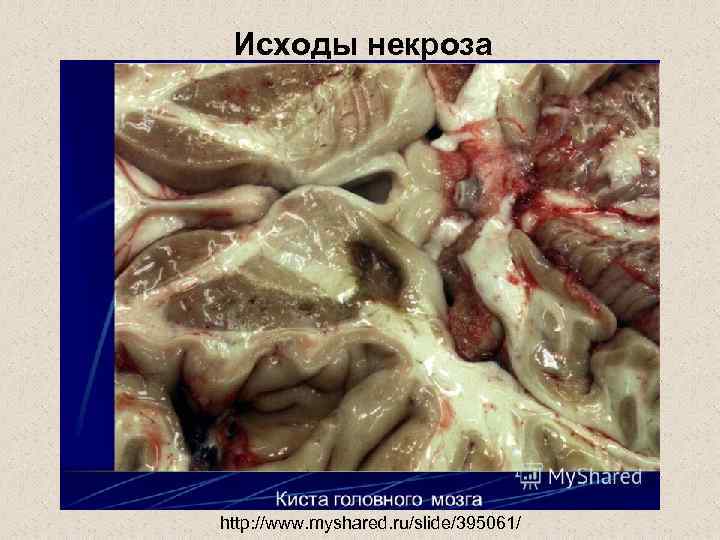  Исходы некроза http: //www. myshared. ru/slide/395061/ 