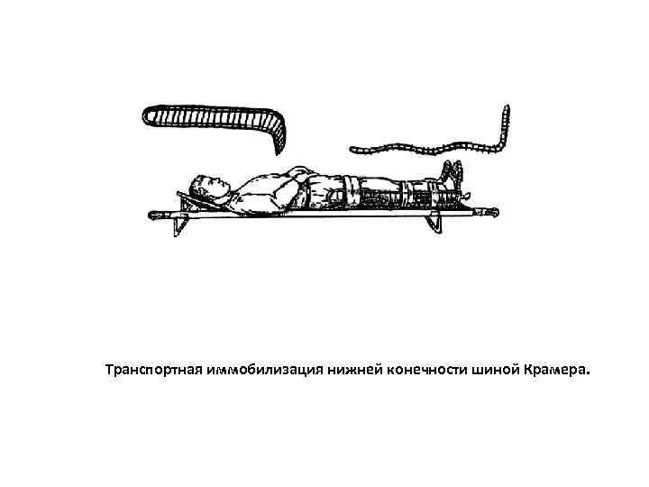 Транспортная иммобилизация нижней конечности шиной Крамера. 