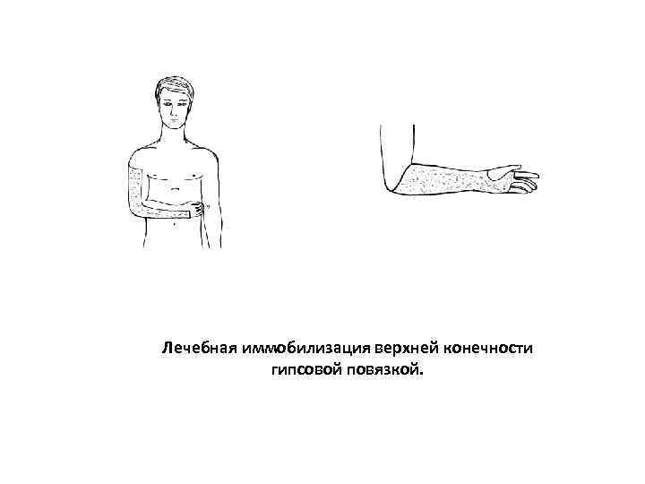 Лечебная иммобилизация верхней конечности   гипсовой повязкой. 