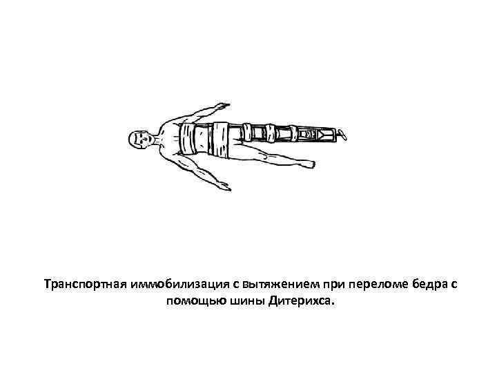 Транспортная иммобилизация с вытяжением при переломе бедра с    помощью шины Дитерихса.