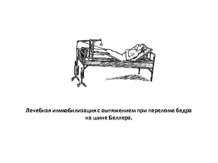 Лечебная иммобилизация с вытяжением при переломе бедра     на шине Беллера.