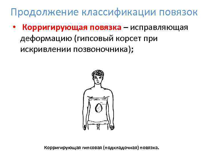 Продолжение классификации повязок •  Корригирующая повязка – исправляющая  деформацию (гипсовый корсет при