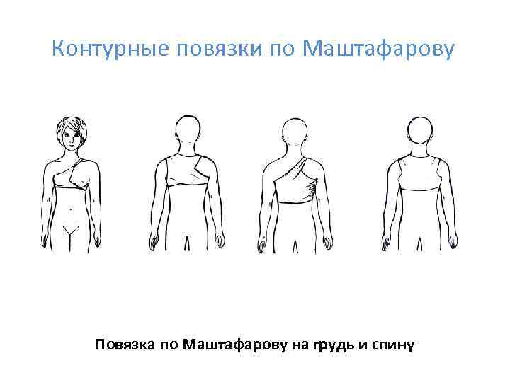 Контурные повязки по Маштафарову  Повязка по Маштафарову на грудь и спину 