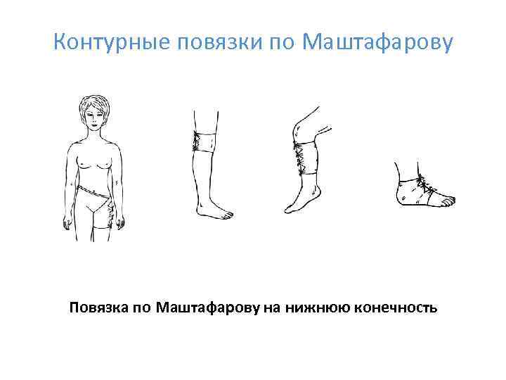 Контурные повязки по Маштафарову Повязка по Маштафарову на нижнюю конечность 