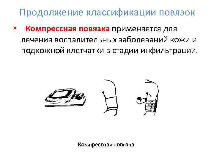  Продолжение классификации повязок •  Компрессная повязка применяется для  лечения воспалительных заболеваний
