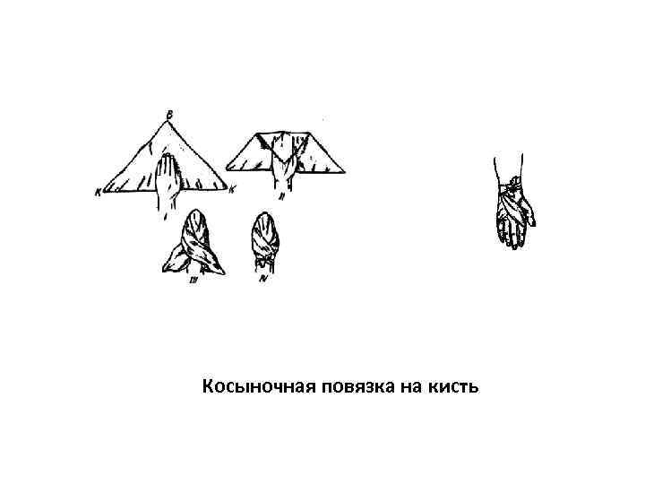 Косыночная повязка на кисть 