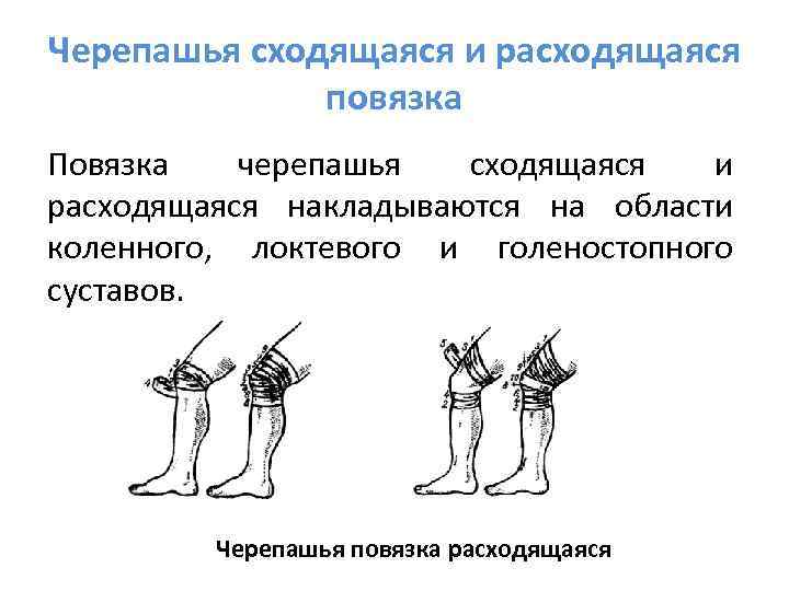 Черепашья сходящаяся и расходящаяся    повязка Повязка черепашья  сходящаяся  и