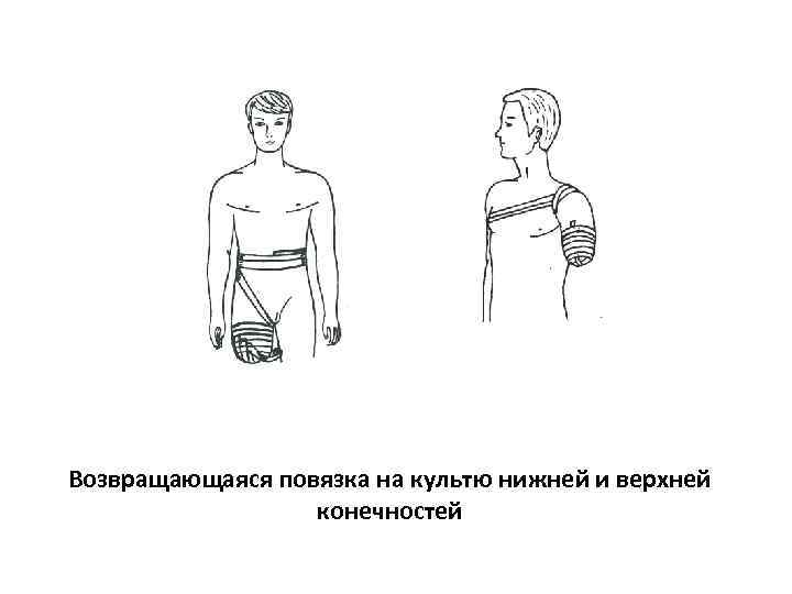Возвращающаяся повязка на культю нижней и верхней    конечностей 