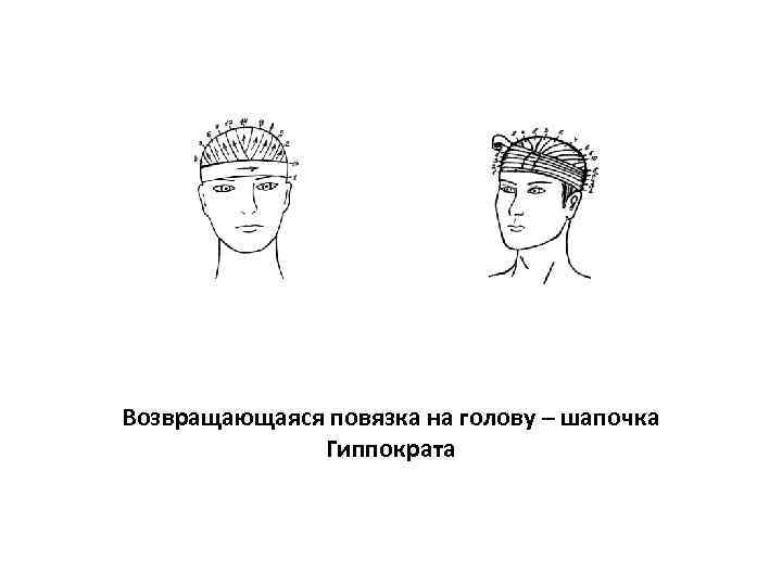 Повязка гиппократа. Возвращающаяся повязка на голову «шапка Гиппократа». Повязка на голову десмургия шапка Гиппократа. Шапочка Гиппократа повязка характеристика. Наложение возвращающейся повязки на голову.