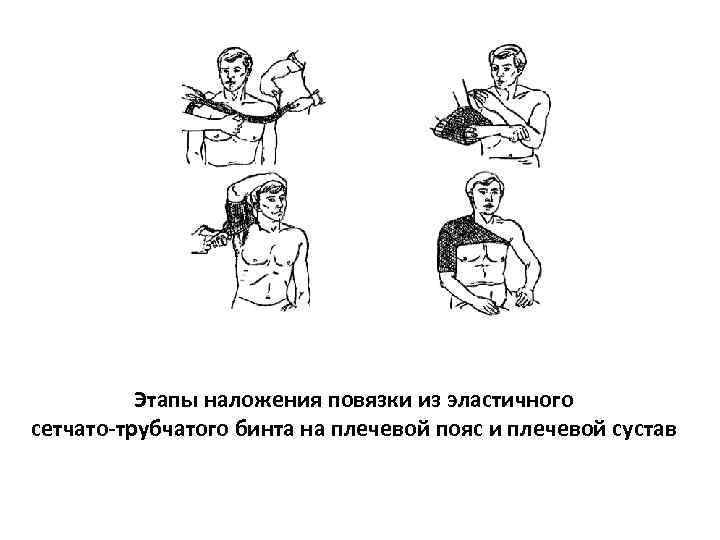    Этапы наложения повязки из эластичного сетчато-трубчатого бинта на плечевой пояс и