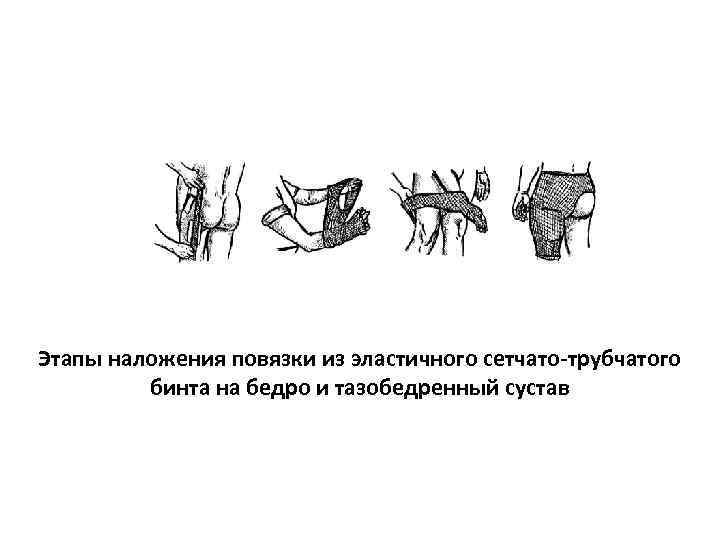 Этапы наложения повязки из эластичного сетчато-трубчатого  бинта на бедро и тазобедренный сустав 