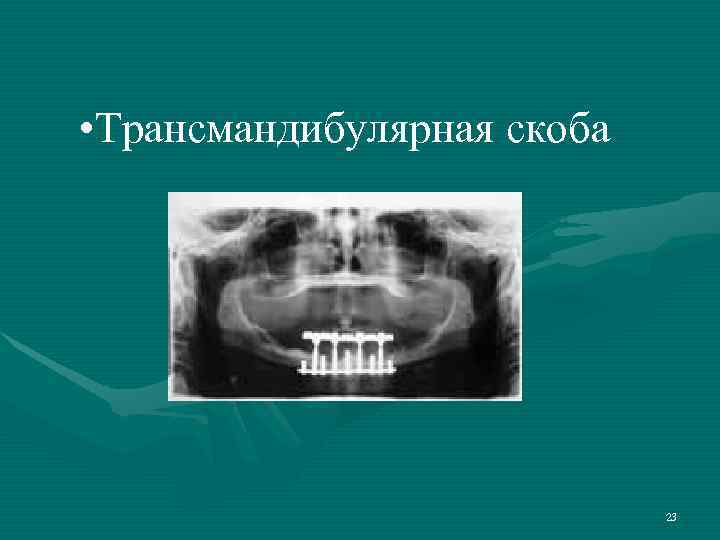  • Трансмандибулярная скоба       23 