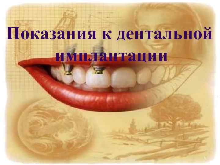Показания к дентальной имплантации     31 