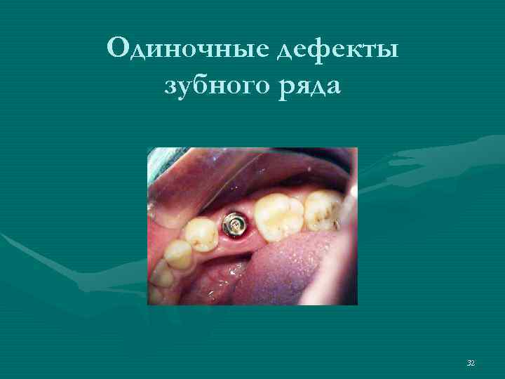 Одиночные дефекты  зубного ряда     32 