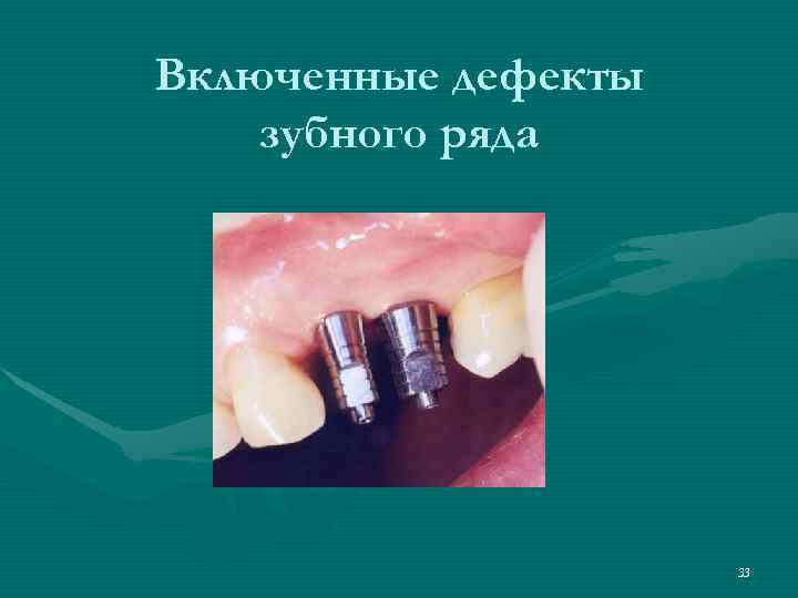 Включенные дефекты зубного ряда     33 