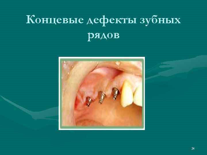 Концевые дефекты зубных   рядов      34 