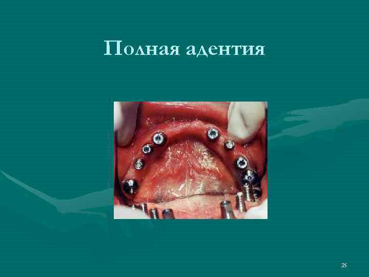 Полная адентия     35 