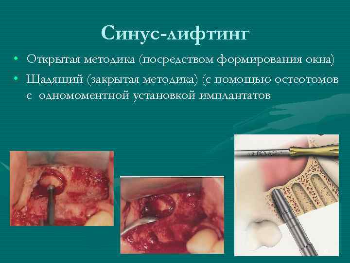    Синус-лифтинг • Открытая методика (посредством формирования окна) • Щадящий (закрытая методика)