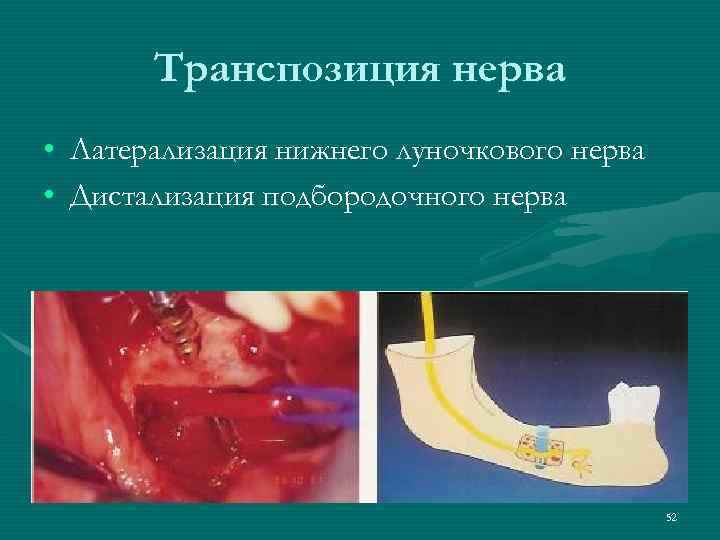   Транспозиция нерва • Латерализация нижнего луночкового нерва • Дистализация подбородочного нерва 