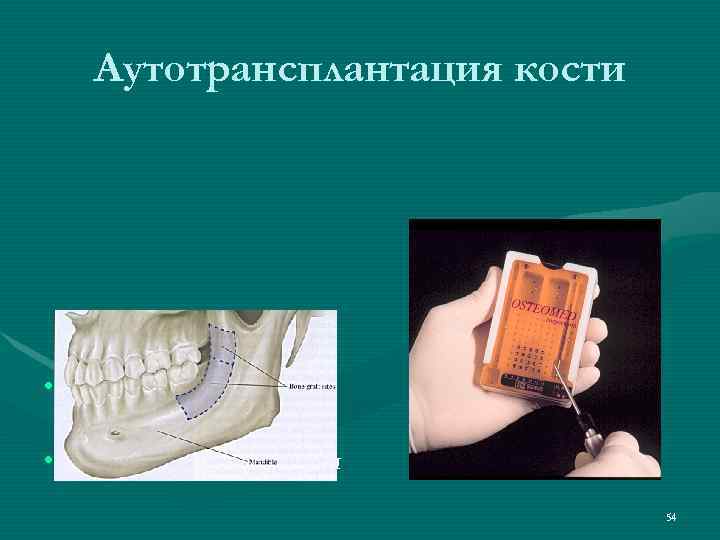   Аутотрансплантация кости • Внутриротовые  источники • Внеротовые источники   