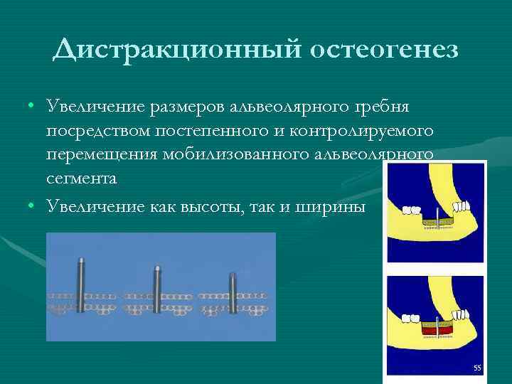  Дистракционный остеогенез • Увеличение размеров альвеолярного гребня  посредством постепенного и контролируемого 
