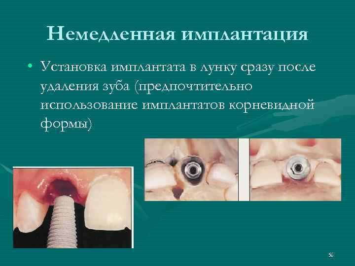  Немедленная имплантация • Установка имплантата в лунку сразу после  удаления зуба (предпочтительно