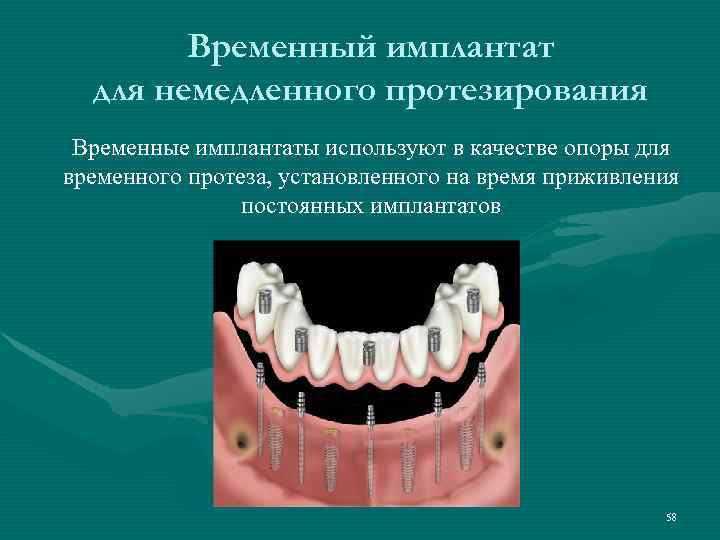   Временный имплантат  для немедленного протезирования Временные имплантаты используют в качестве опоры