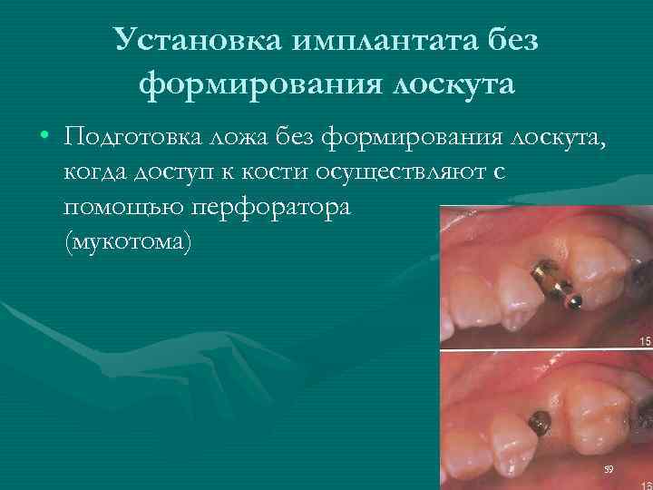  Установка имплантата без  формирования лоскута • Подготовка ложа без формирования лоскута, 