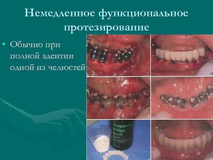  Немедленное функциональное  протезирование • Обычно при  полной адентии  одной из