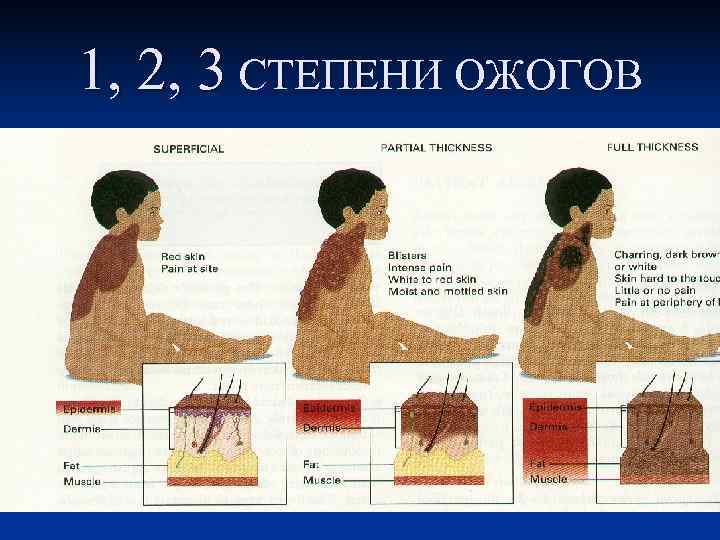 1, 2, 3 СТЕПЕНИ ОЖОГОВ 