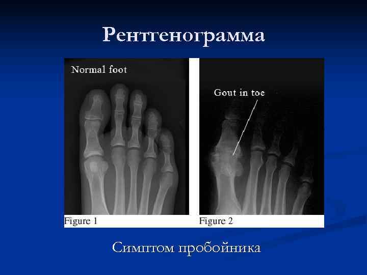 Рентгенограмма Симптом пробойника 