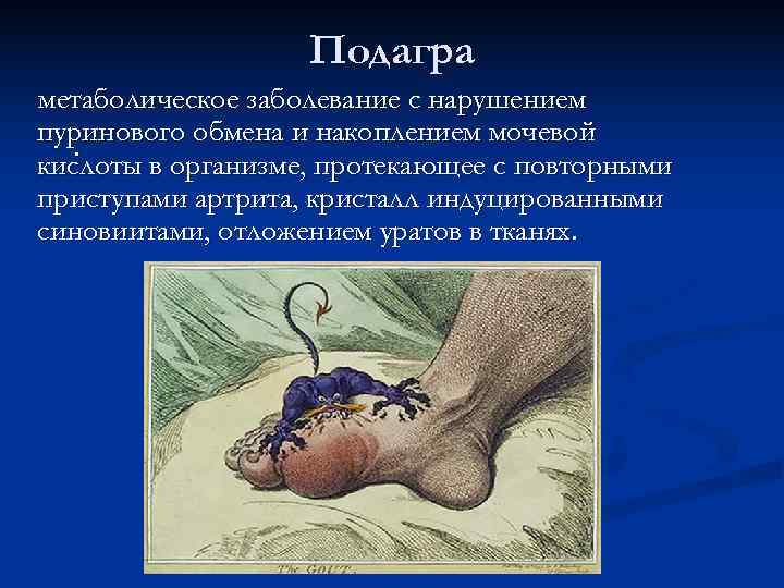     Подагра метаболическое заболевание с нарушением пуринового обмена и накоплением мочевой